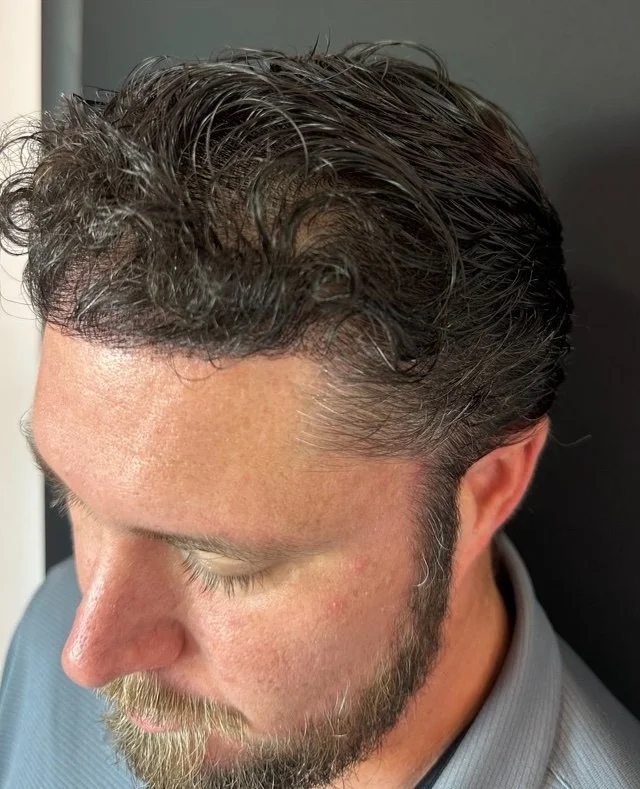FUE hair transplant — after