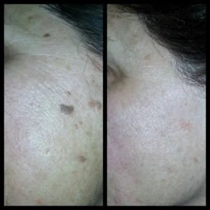 Photofacial before and after