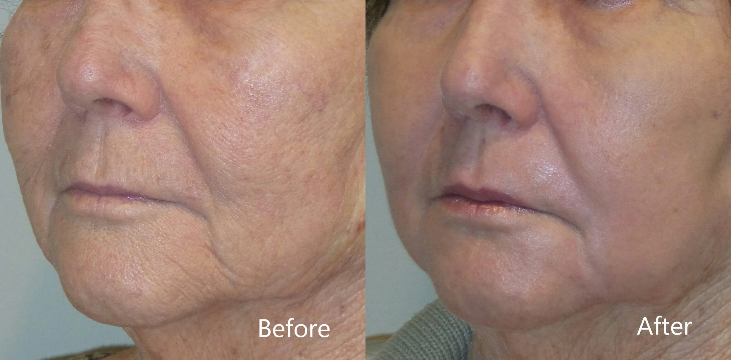 Deep fractional laser in Ponte Vedra