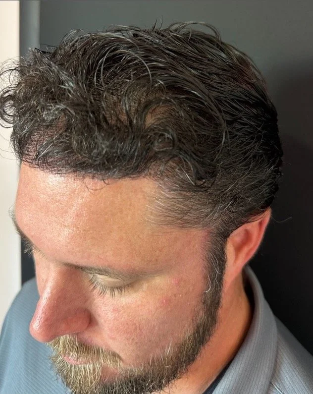 Introducing FUE Hair Transplant: Redefining Confidence and Radiance at Laser Loft, Ponte Vedra, FL
