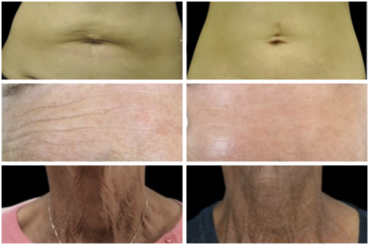 Skin resurfacing before and after in Ponte Vedra
