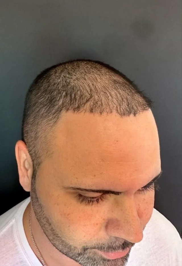 FUE hair transplant — after