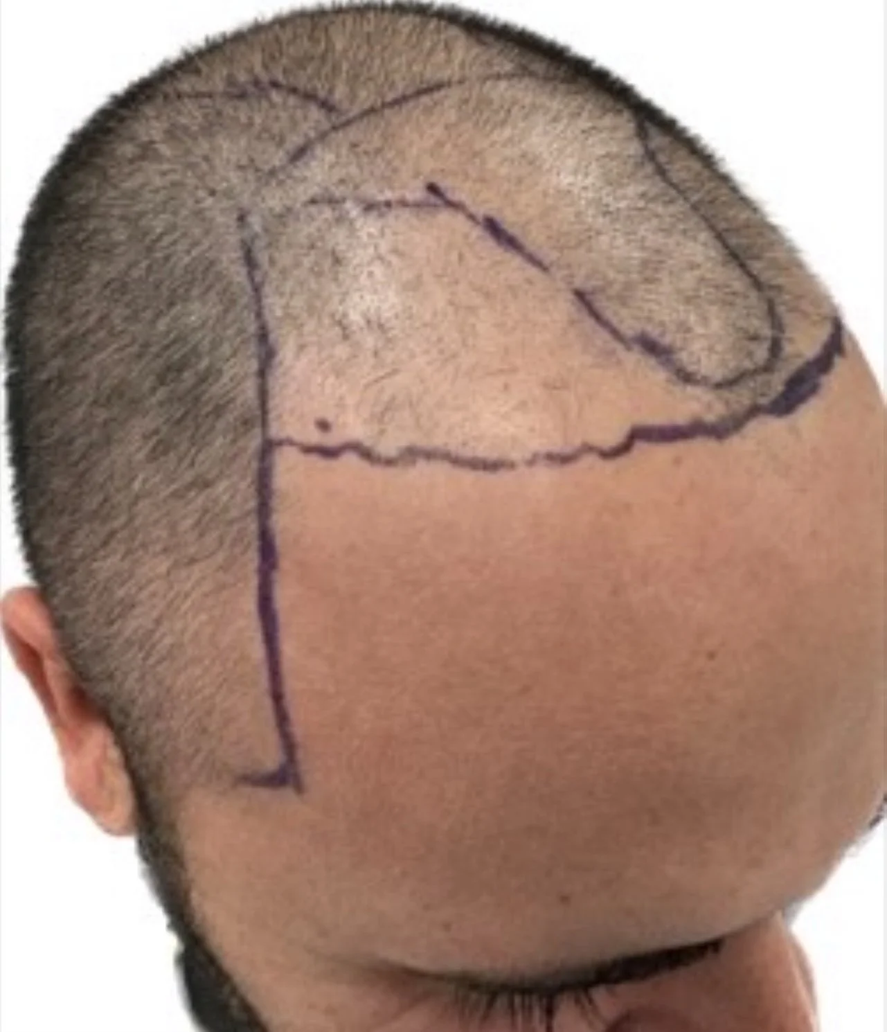 FUE hair transplant — before