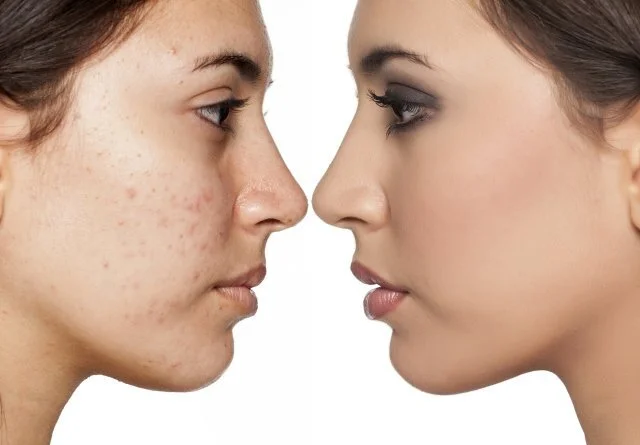 Microneedling in Ponte Vedra